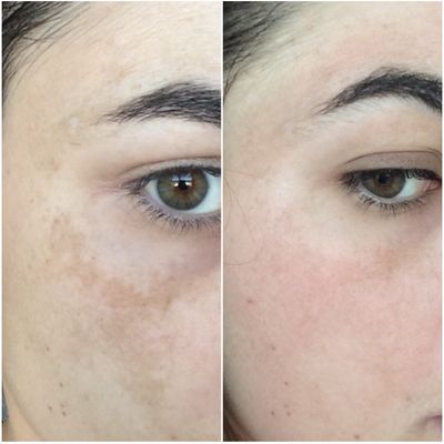 Glutathione 7 Serum Patch