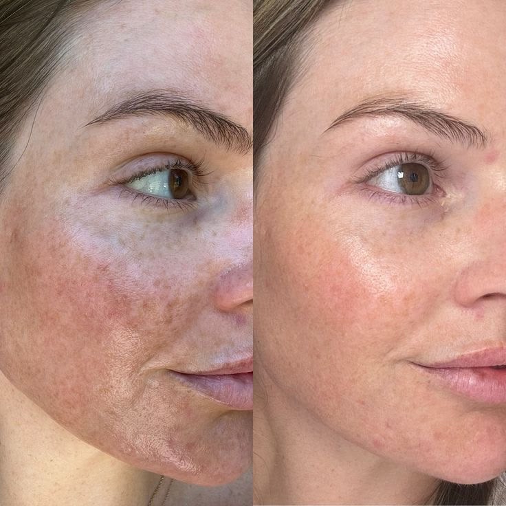 Glutathione 7 Serum Patch